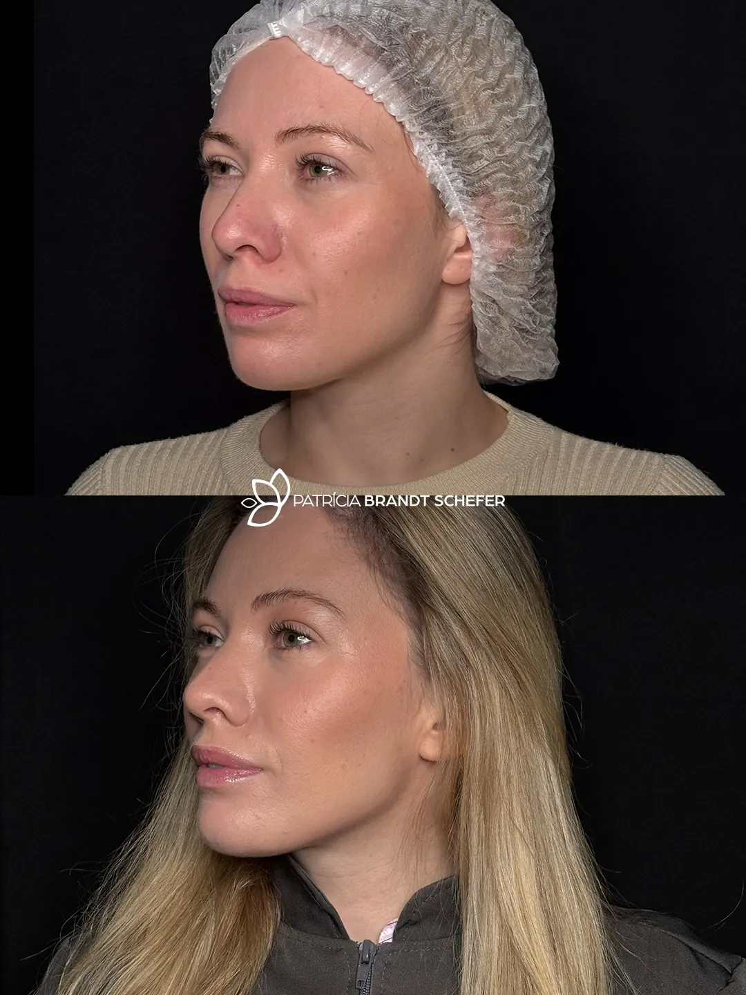 Antes e depois de harmonização facial em vista oblíqua