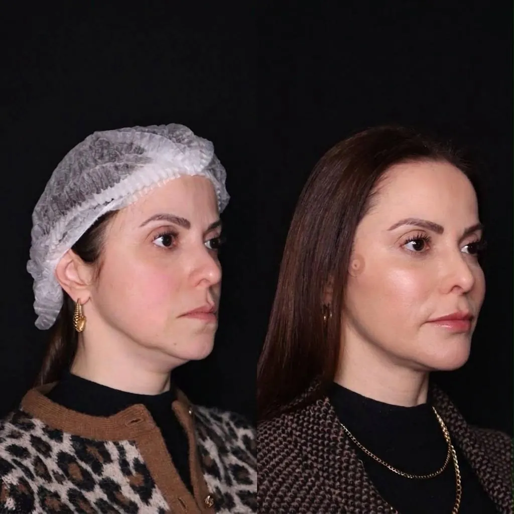 Antes e depois de harmonização facial em vista oblíqua