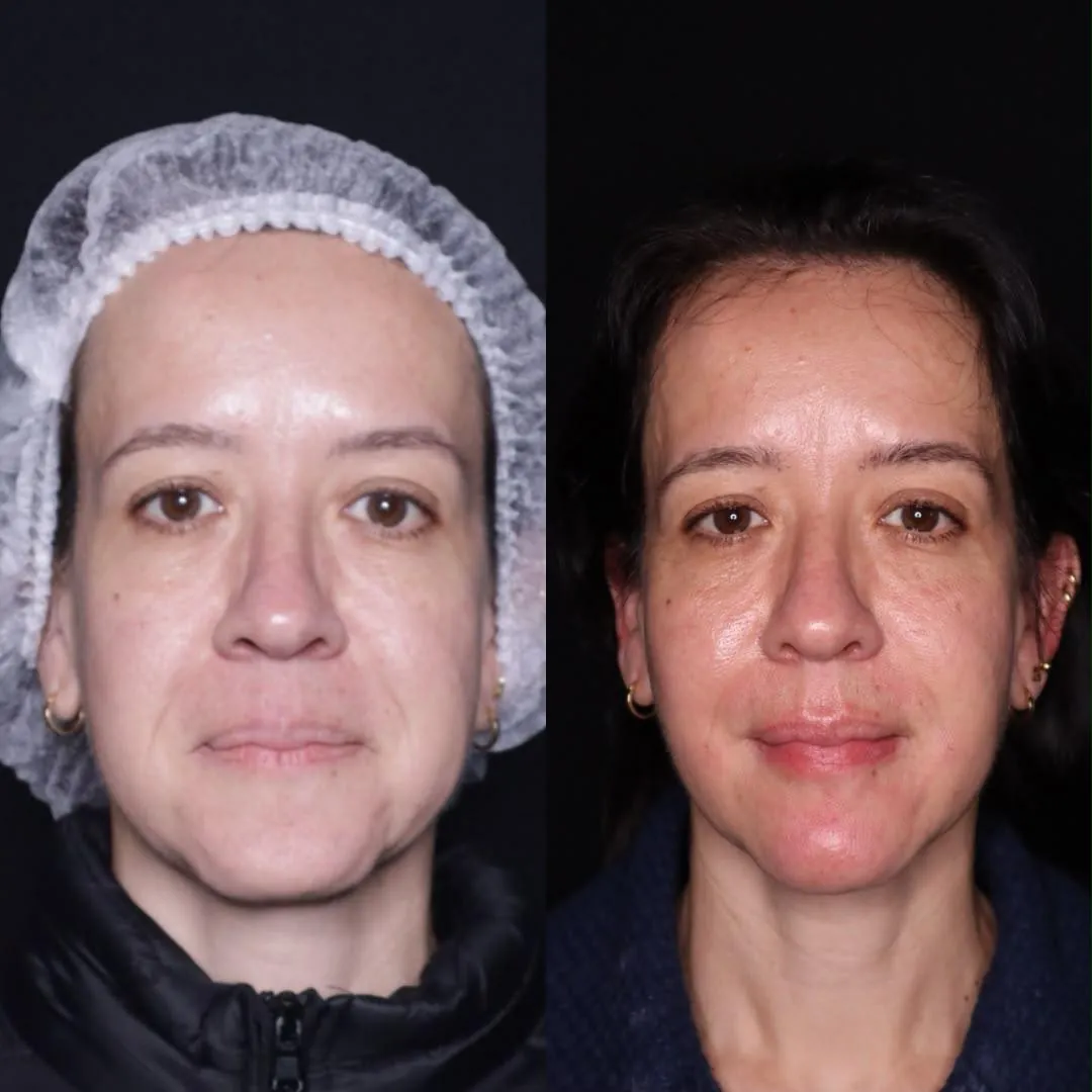 Antes e depois de harmonização facial em vista frontal