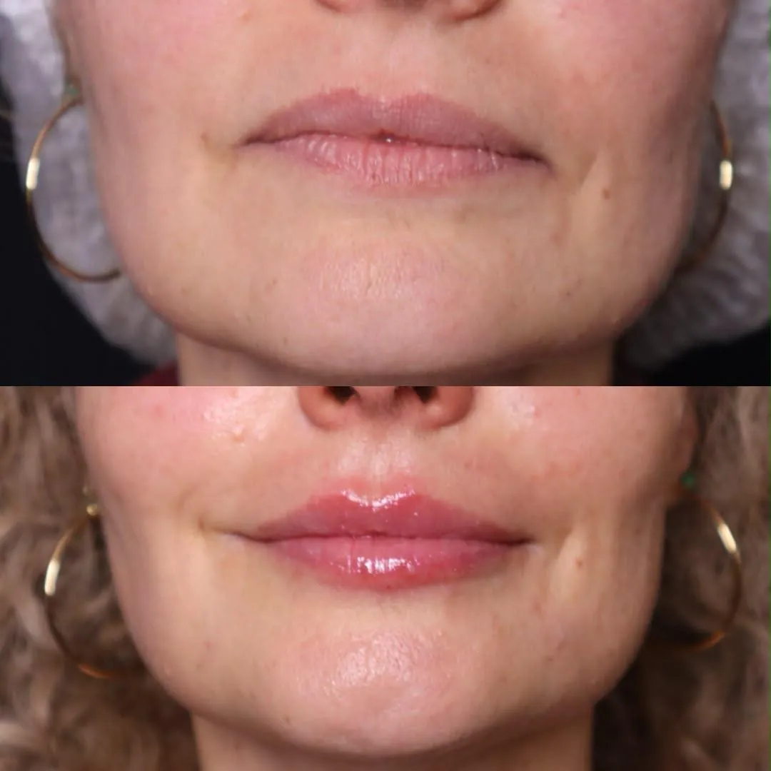 Antes (acima) e depois (abaixo) de preenchimento labial