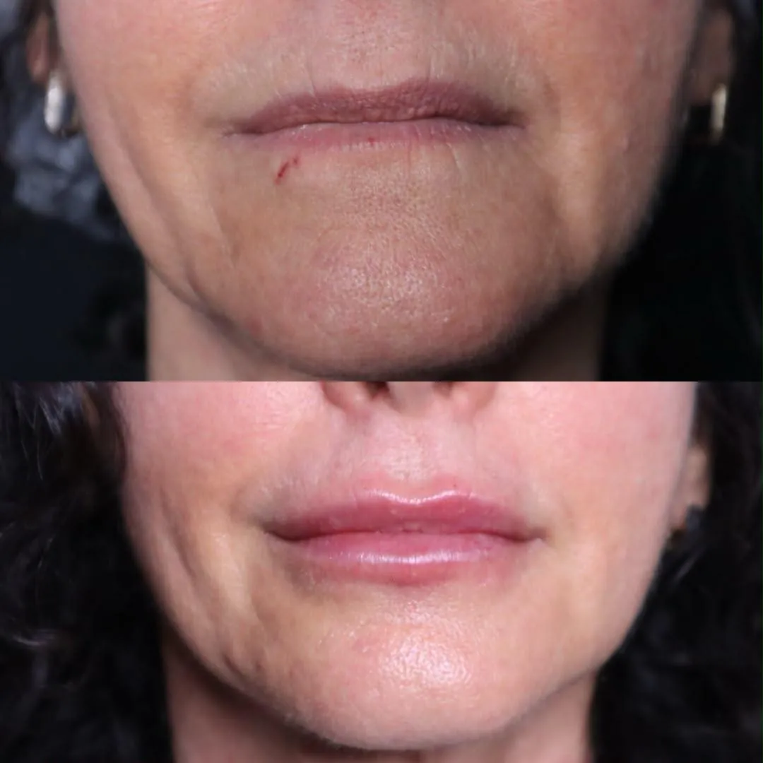 Antes (acima) e depois (abaixo) de preenchimento labial