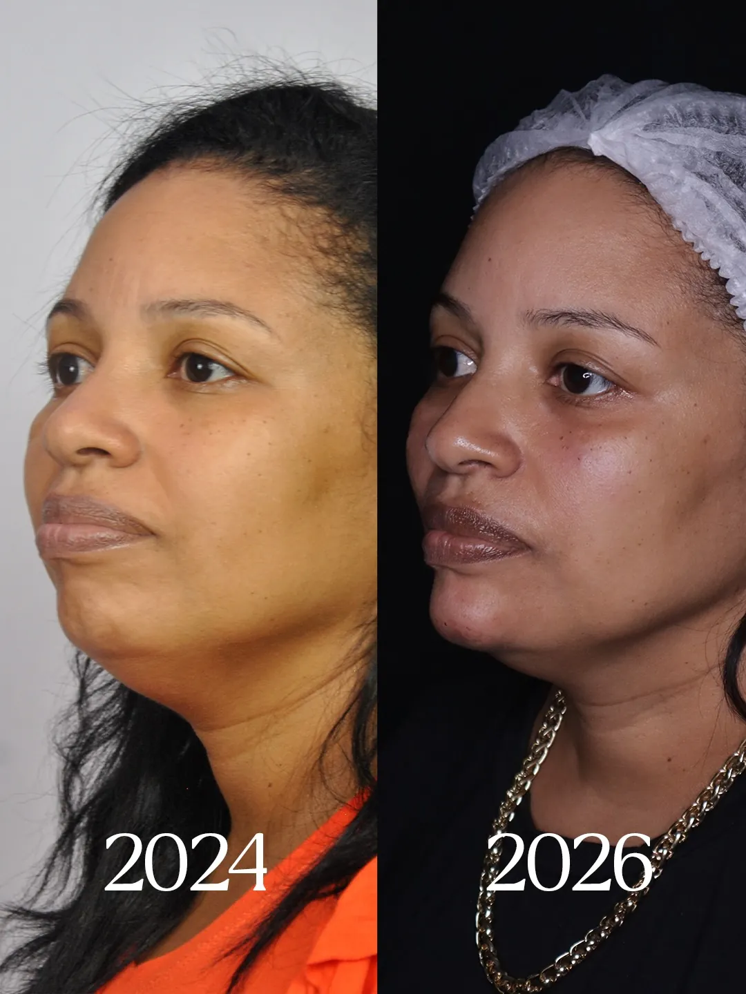 Antes e depois de harmonização facial em vista lateral, 2024 e 2026