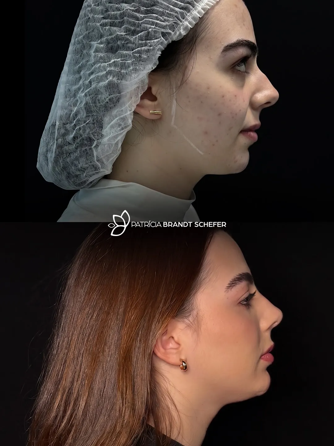 Antes e depois de perfiloplastia em perfil
