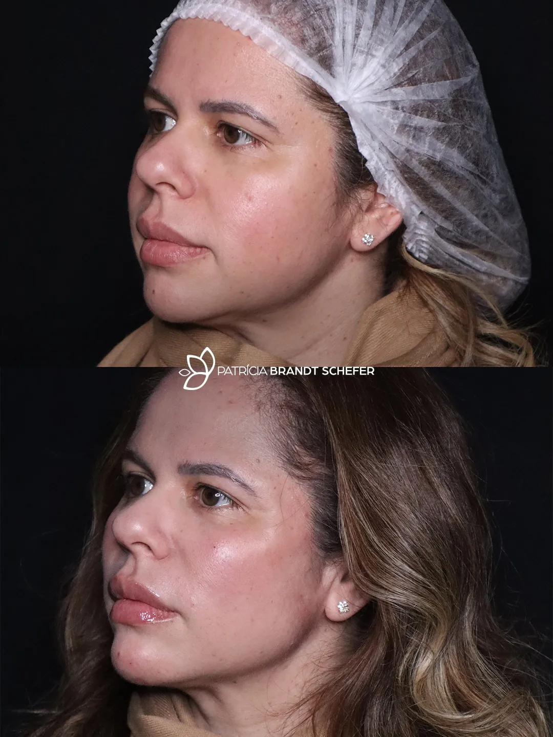 Antes e depois de harmonização facial em vista oblíqua